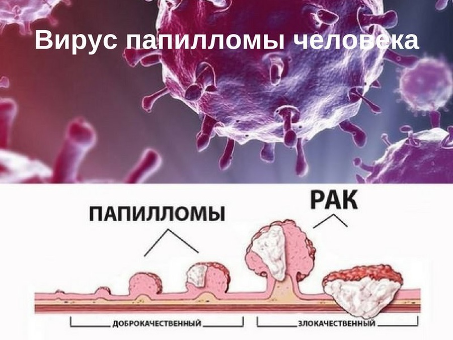 Paraziták tűkezelése, a Vph vakcin hatással van a másodlagosokra